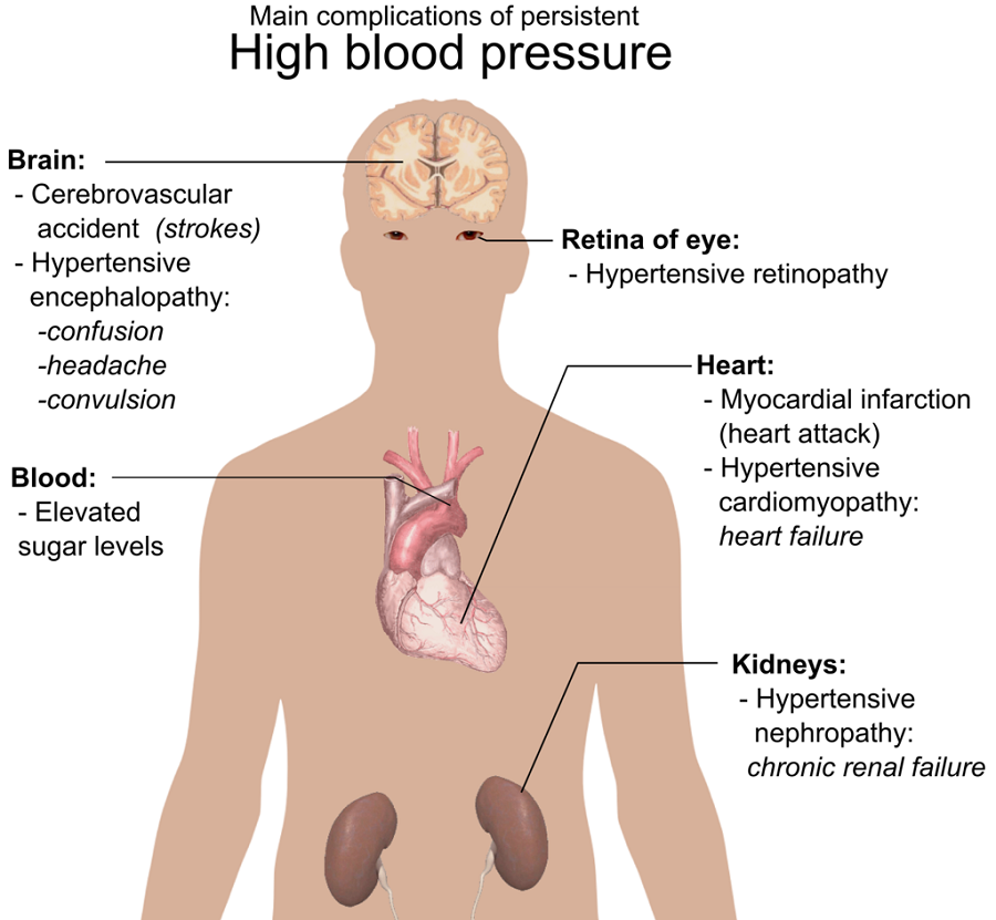 Complications of high blood pressure include strokes, hypertensive encephalopathy, confusion, headache, convulsion. , hypersensitive retinopathy, elevated sugar levels, heart attack, heart failure, and chronic renal failure.